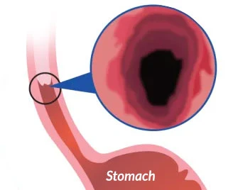 Barrett’s oesophagus
