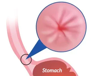 Normal lower oesophagus