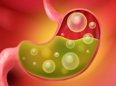 acid reflux