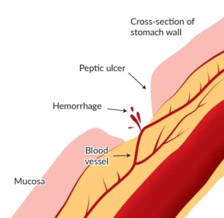 bleeding ulcer bleeding ulcer