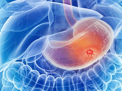peptic ulcer