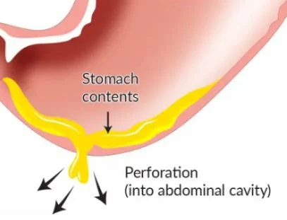 perforation perforation